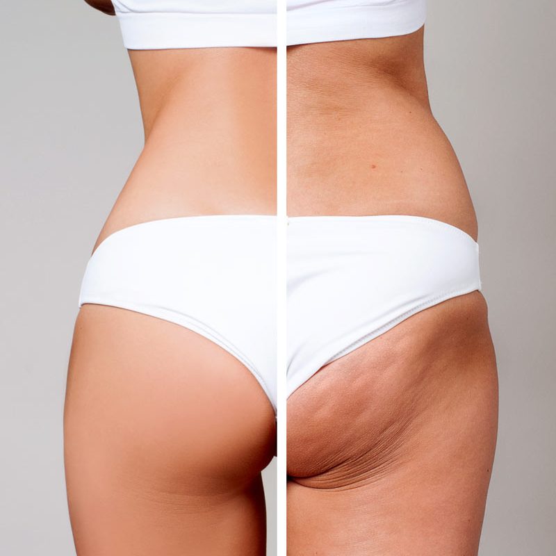 ANTI-CELLULITE TREATMENT - The Wrinkle Room